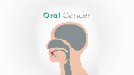 Oral cancer