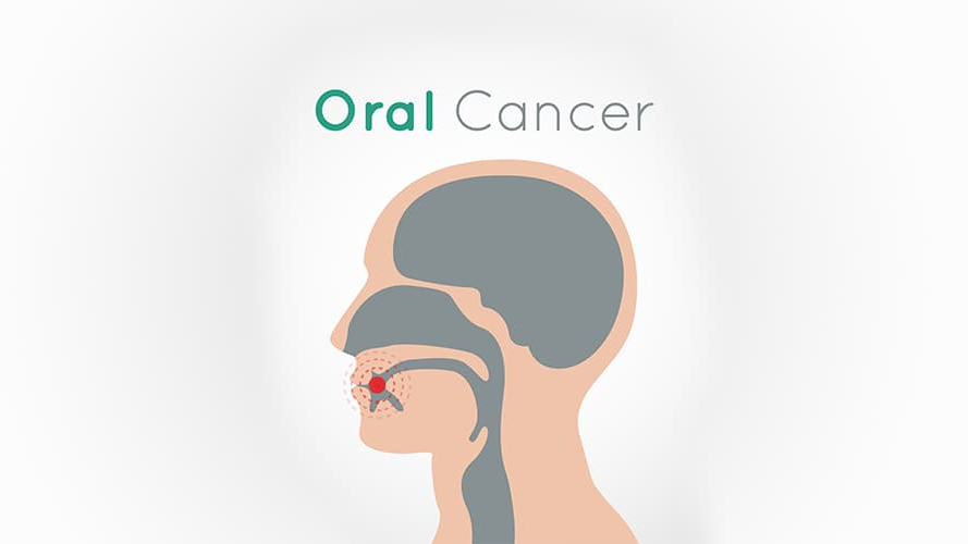 Oral cancer