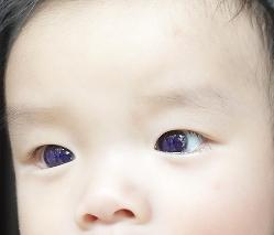 Thai baby's brown eyes blue