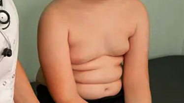 Early treatment of obesity in childhood is effective in both long and short term, according to the study.
