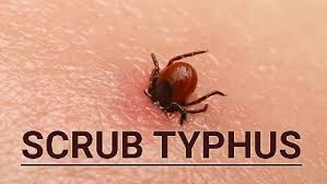 At least 16 more Scrub Typhus cases were detected in Odisha’s Sundergarh district in the last 24 hours.