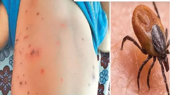 As many as six Scrub Typhus positive cases were detected on Thursday in Sundergarh district taking the total number of patients in the district to 403 so far.
