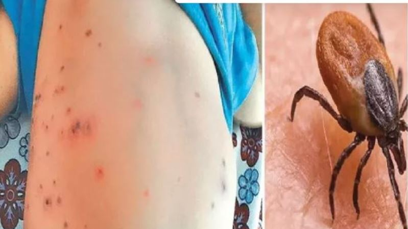 At least one Scrub Typhus positive cases was detected on Friday in Sundergarh district taking the total number of patients in the district to 404 so far.