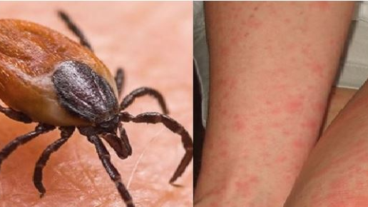 At least 11 Scrub Typhus-positive cases were detected on Tuesday in Sundergarh district taking the total number of patients in the district to 441 so far