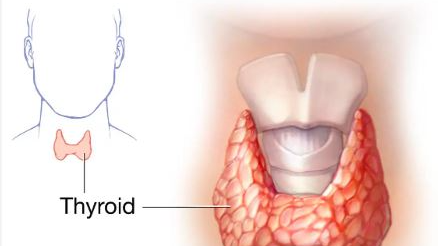 Thyroid disorders refer to conditions that affect the thyroid gland, a small butterfly-shaped gland located in the neck. 