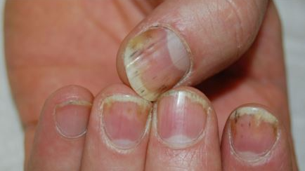 A recent study conducted by scientists at the US National Institutes of Health (NIH) has uncovered a significant correlation between a specific nail abnormality and the risk of developing cancerous tumors of the skin, eyes, and kidneys.