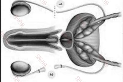 Male vasectomy in Odisha