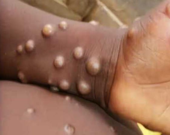 Mpox scare: Odisha Health Dept says not to panic