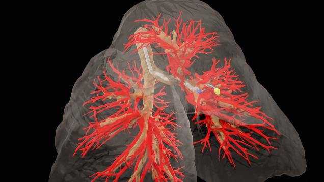 To drive through tissue, the needle needs to know where it is going. The research team used CT scans of the subject's thoracic cavity and artificial intelligence to create three-dimensional models of the lung, including the airways, blood vessels