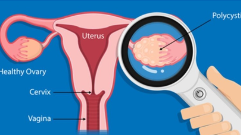 Polycystic ovary syndrome is a hormonal disorder that is defined by irregular menstruation and elevated levels of a hormone called Androgen