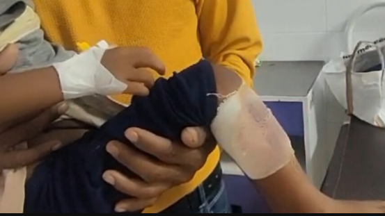 According to reports, the sisters identified Namita Raika and Sushila Raika were watching a video on the mobile phone when it unexpectedly exploded, resulting in severe injuries. One sister suffered hand injuries, while the other sustained burns on her leg