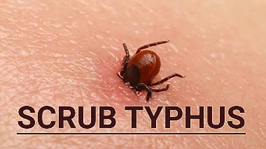  As many as 13 people have been diagnosed with Scrub Typhus disease in Burla Vimsar in the last 24 hours, while two people have lost their lives due to this disease. 